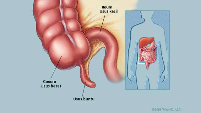 Benarkah, Makan Makanan Pedas Bisa Sebabkan Usus Buntu?