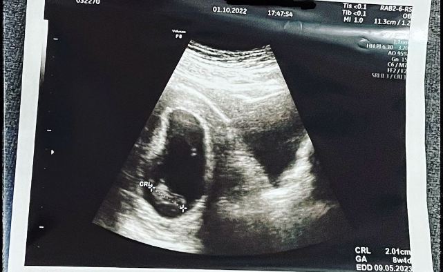 Via Vallen Sedih, Umumkan Hamil Muda tapi Janin Tak Berdetak